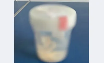 Nezvyčajný medicínsky prípad ako varovanie. To, čo pacient vykašľal, lekárov z Nitry šokovalo